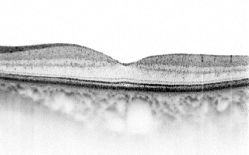 正常眼の黄斑OCT（光干渉断層撮影）