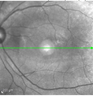 中心性漿液性網脈絡膜症の黄斑OCT