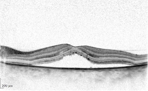 中心性漿液性網脈絡膜症の黄斑OCT