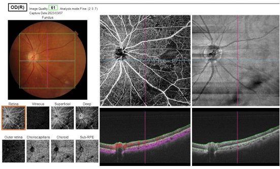 OCT、OCT-A、眼底写真：DRI OCT Triton