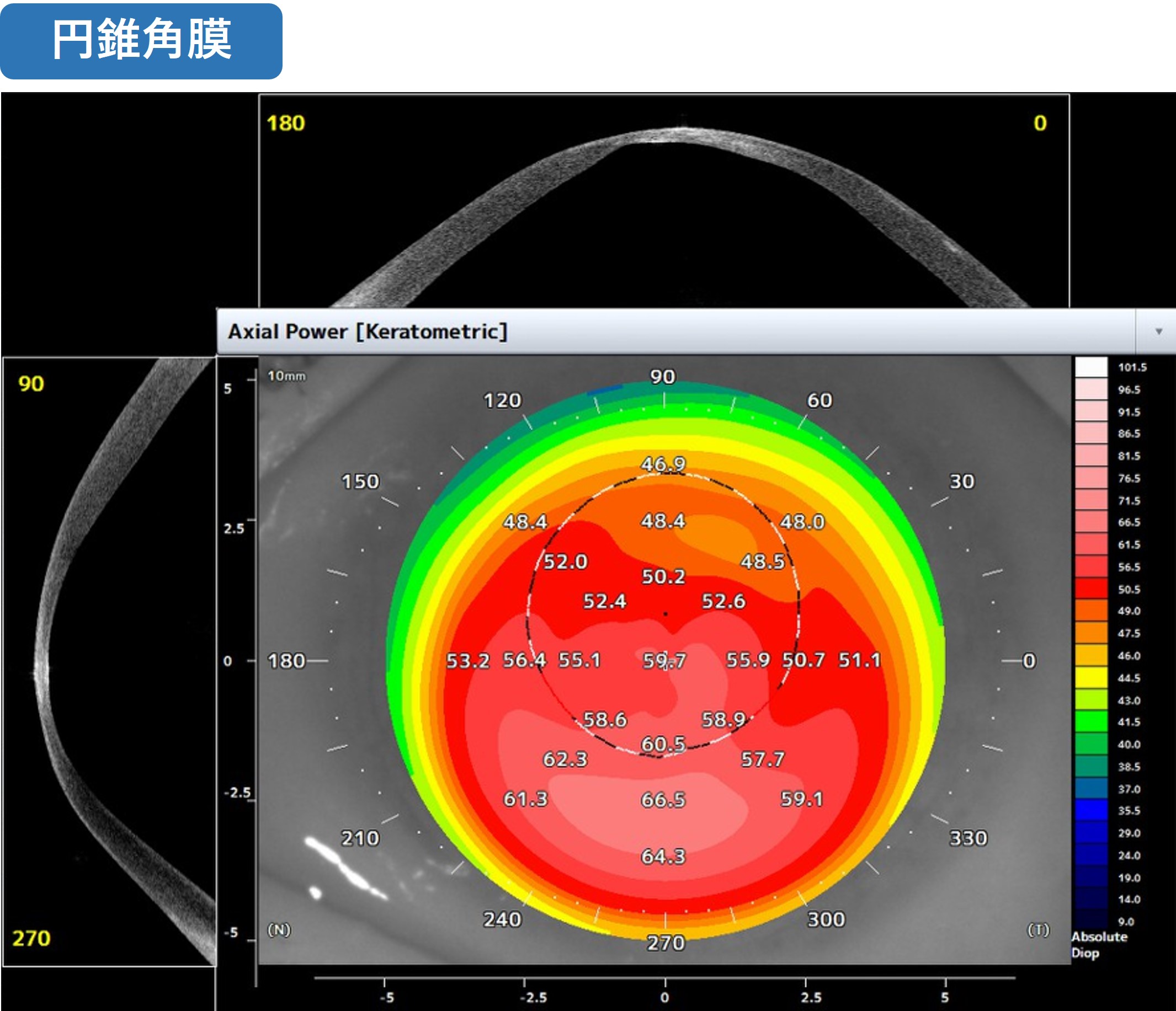 円錐角膜_形状解析