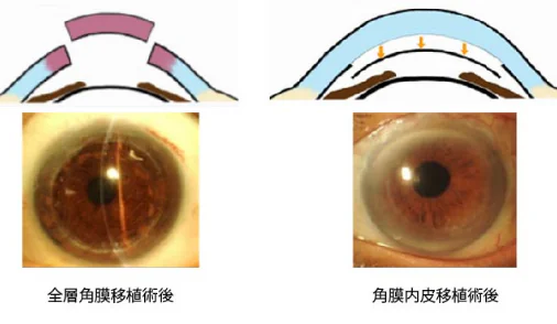図4 角膜移植のシェーマと移植後の前眼部写真