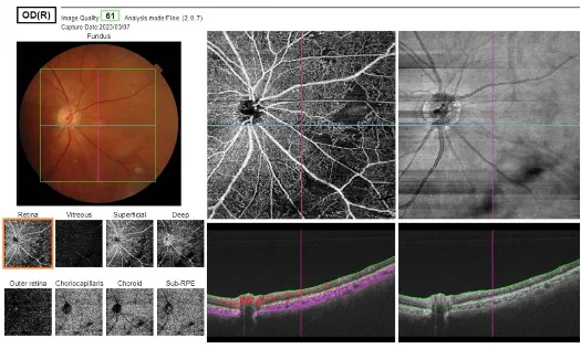 三次元画像眼底像撮影装置（OCT）、光干渉断層血管撮影（OCTA）（図5）