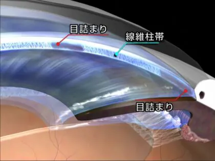 隅角解放緑内障