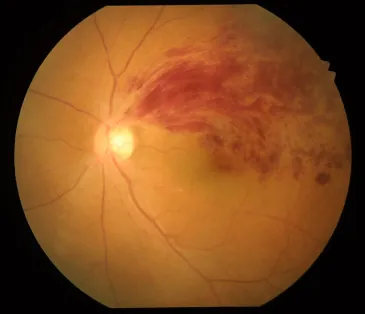 網膜静脈分枝閉塞症の眼底写真