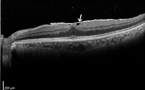 黄斑上膜（黄斑前膜）のOCT。網膜の表面に膜が張っている（矢印）