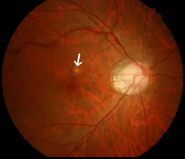 近視による脈絡膜新生血管の眼底写真（矢印）
