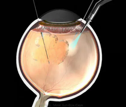 網膜剥離の治療