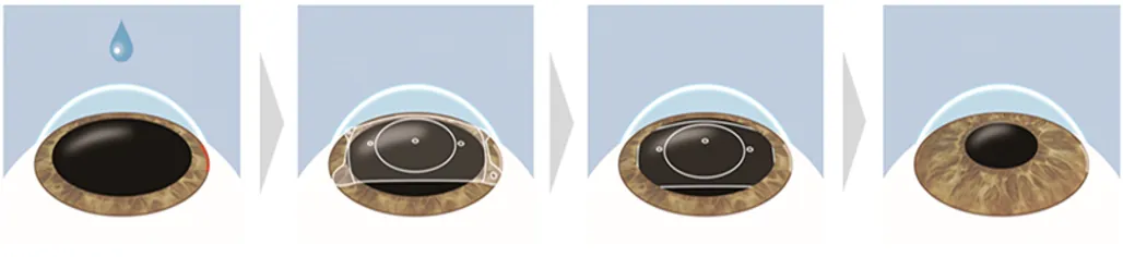 図9 ICL手術のシェーマ<br>角膜の端に約3mmの小さな創口を作製し、目の中に二つ折りに畳んだレンズを入れた後に、虹彩の下に埋め込む。