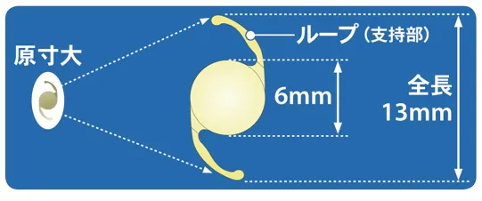 眼内レンズとは？