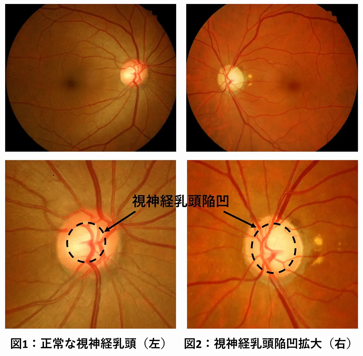 図1：正常な視神経乳頭（左）　  　図2：視神経乳頭陥凹拡大（右）