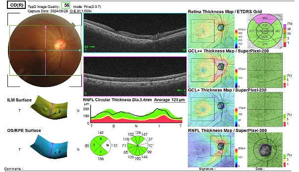 図3：OCT検査　（視神経乳頭の形状解析結果）