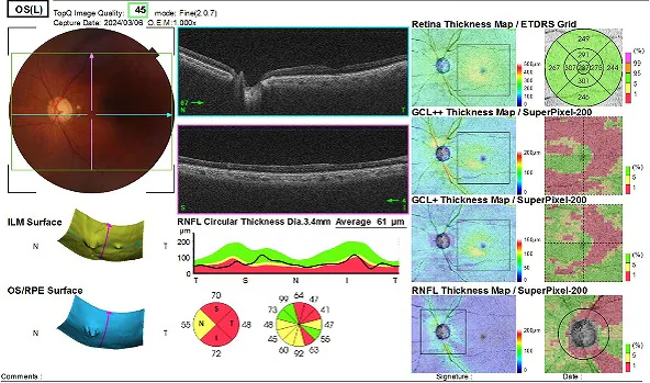 図3：OCT検査　（視神経乳頭の形状解析結果）