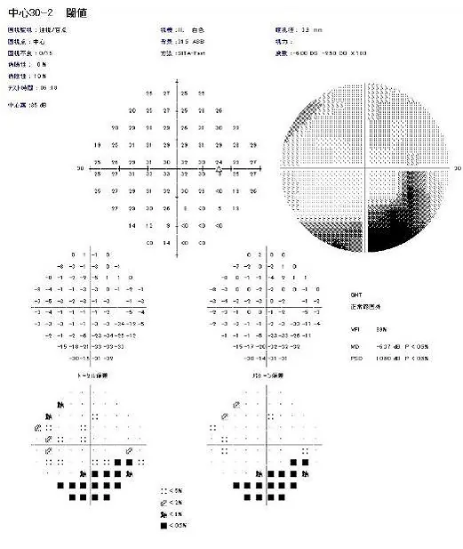 図５：眼底検査、視野検査、OCT検査結果