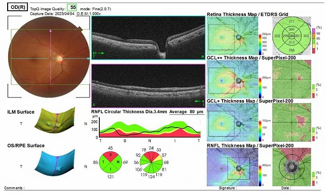 図５：眼底検査、視野検査、OCT検査結果