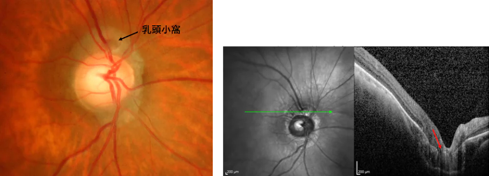 図6：眼底検査、OCT検査結果