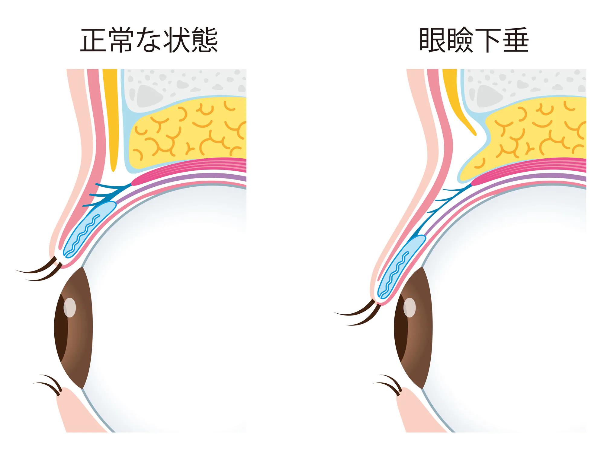 眼瞼下垂