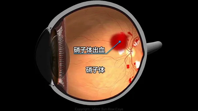 硝子体出血